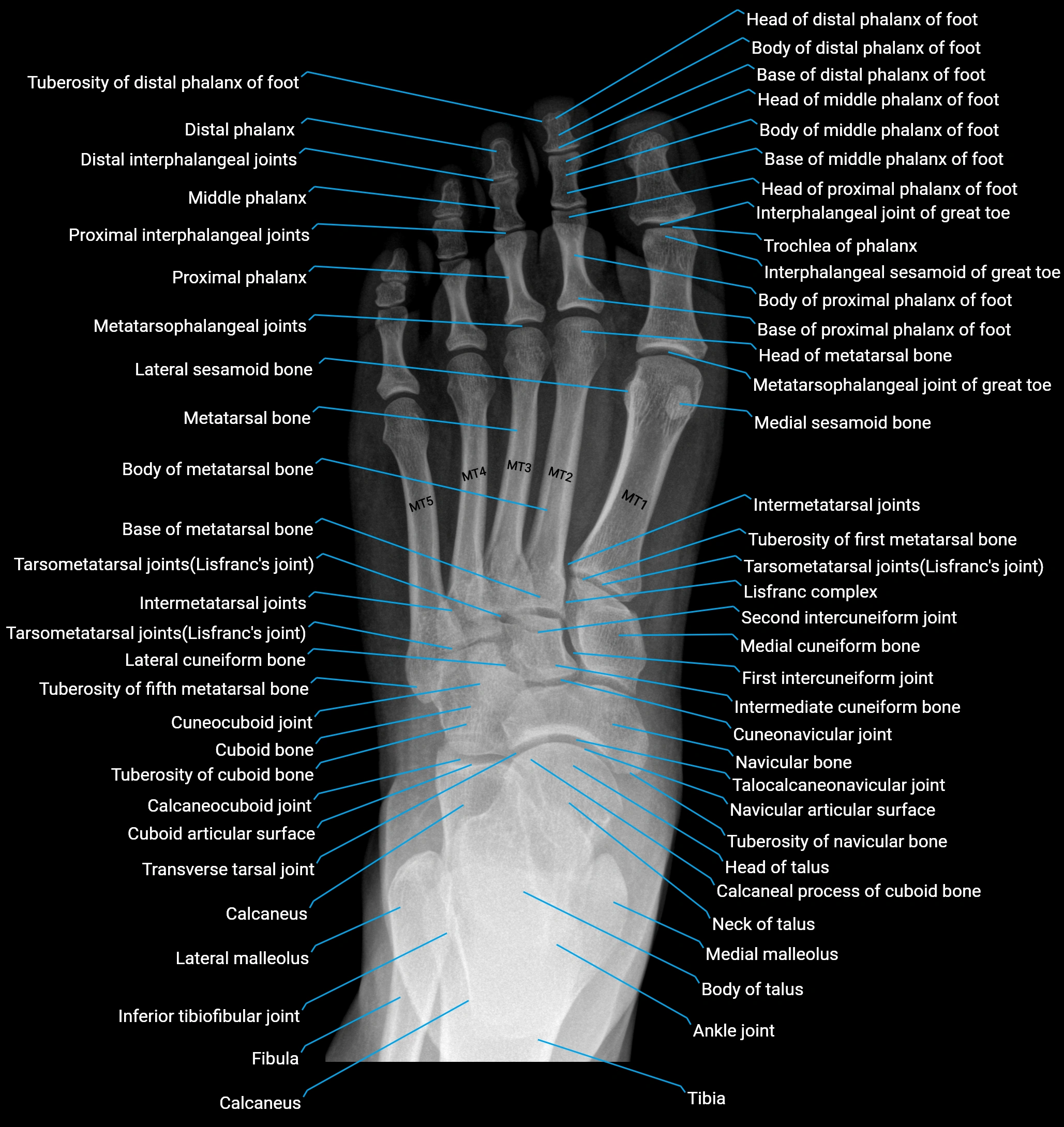 X ray  foot AP anatomy labelled image.webp